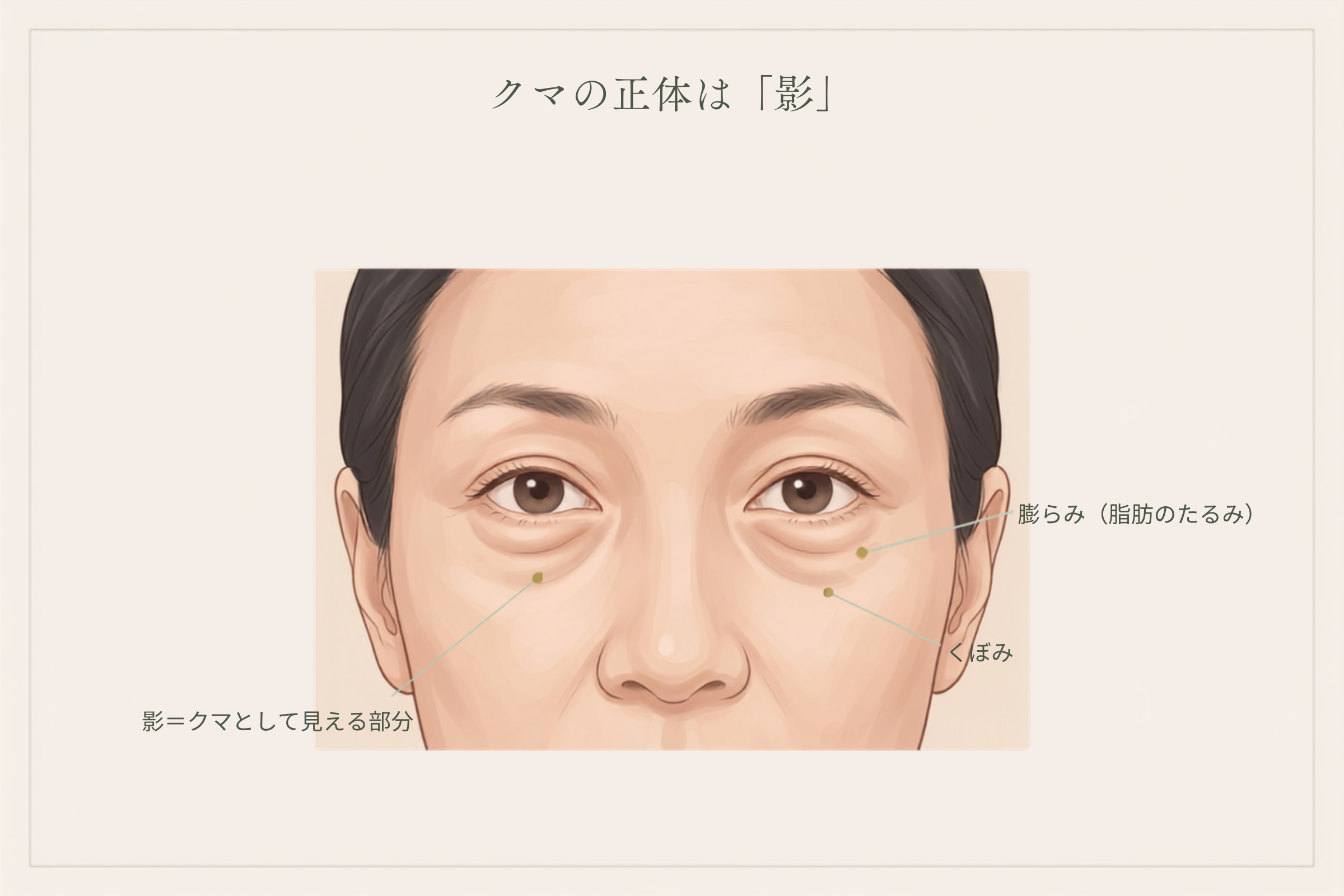 目の下の膨らみ・くぼみ・影の位置を示した目元の図解