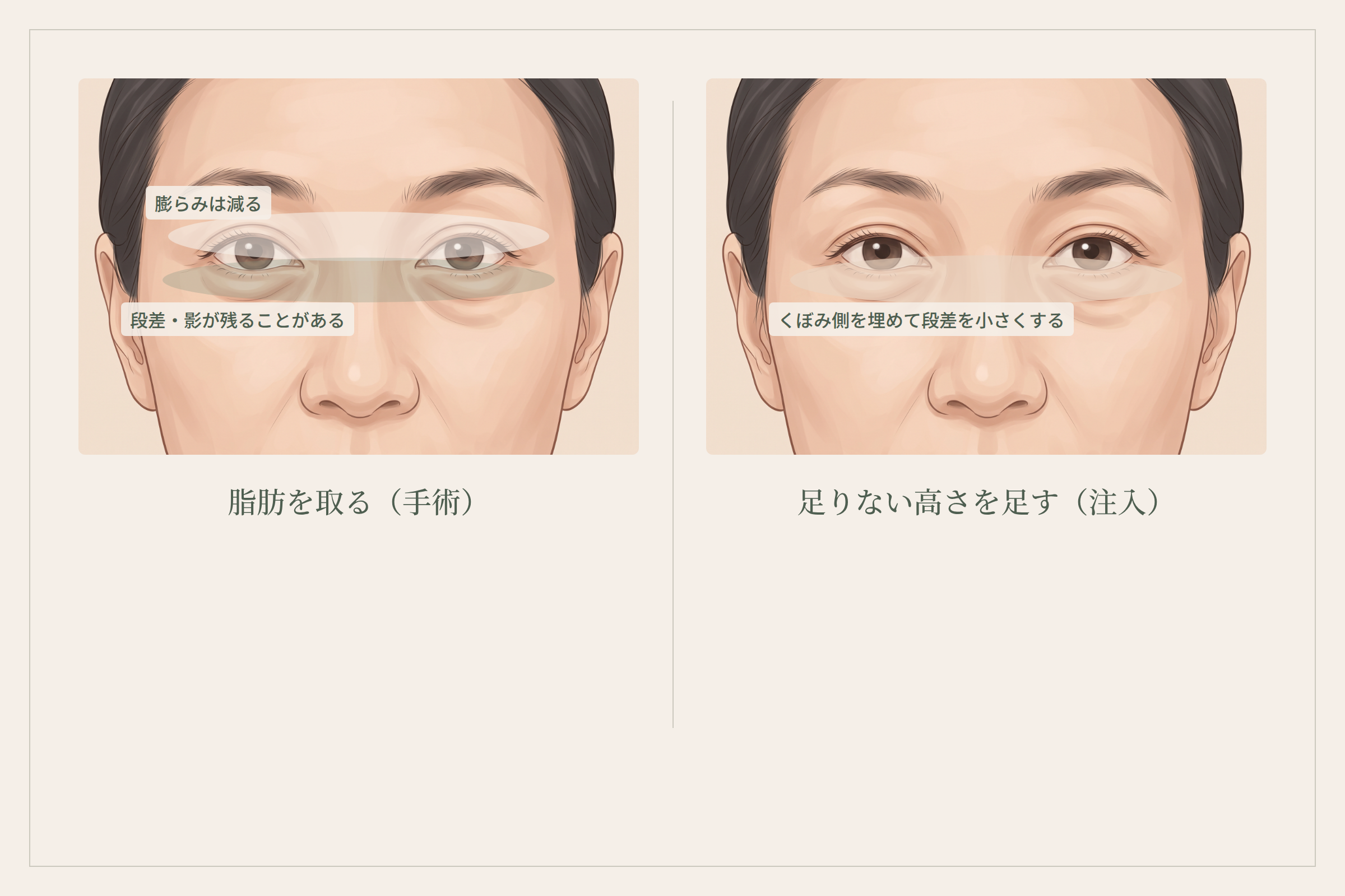 脂肪を取る手術と足りない高さを足す注入治療の目元比較図(同一人物・オーバーレイで違いを表現)