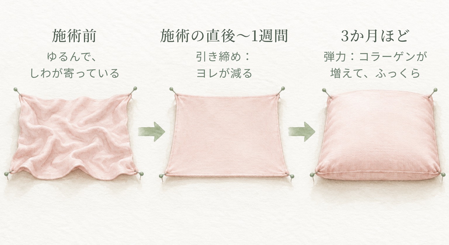 施術前のしわの寄った布が、施術の直後〜1週間で引き締まってヨレが減り、3か月ほどでコラーゲンが増えて厚みと弾力が出る様子を表した図