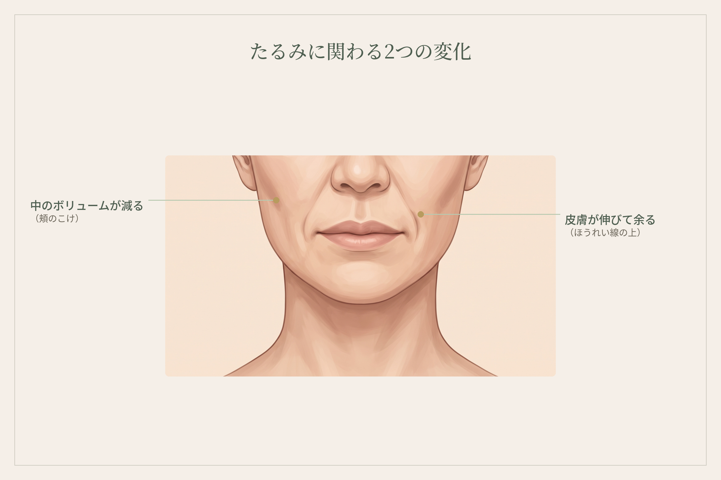 頬のこけ(中のボリュームの減り)と、ほうれい線の上に乗ってくる皮膚(皮膚の伸び)の場所を示した顔のイラスト
