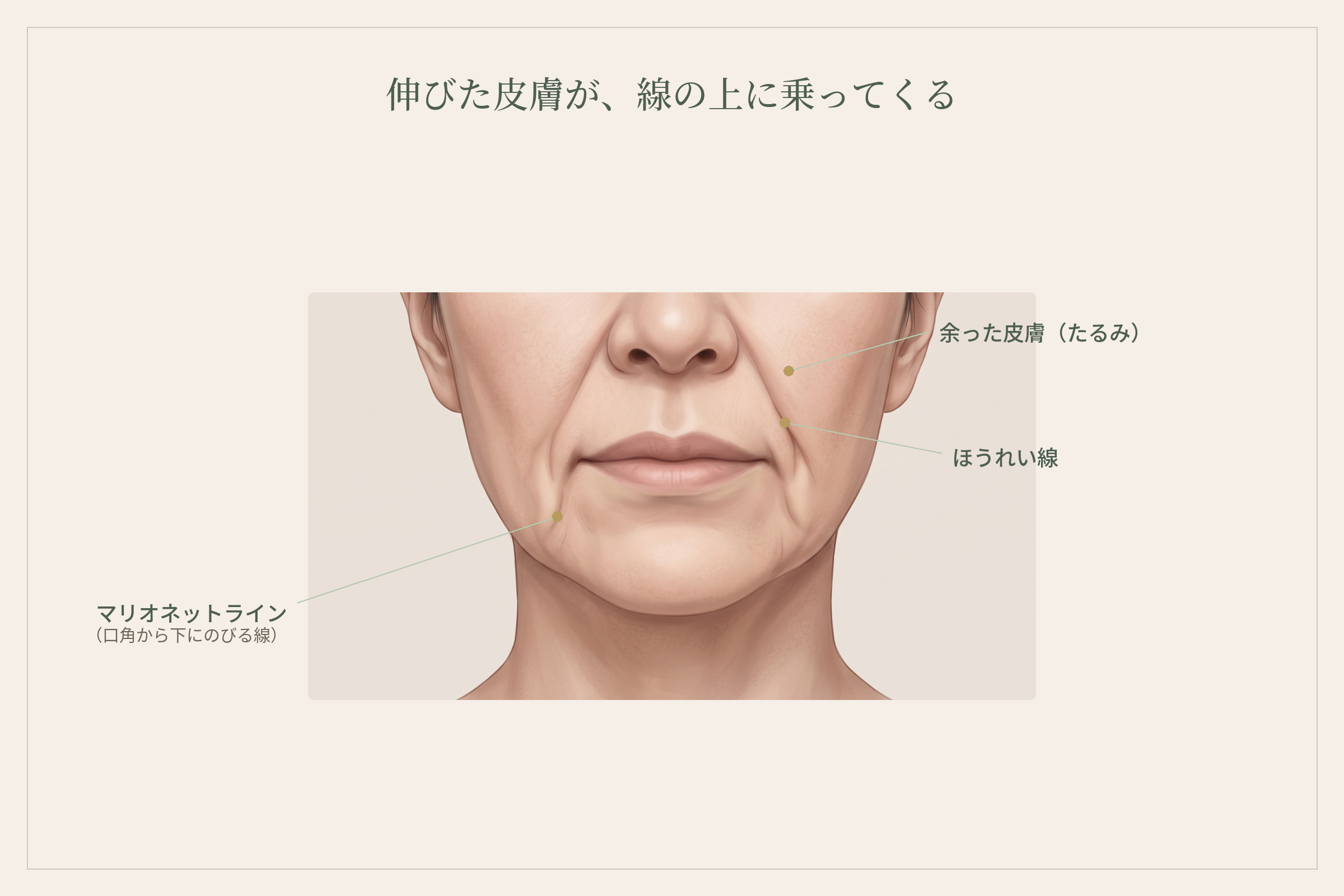 伸びて余った頬の皮膚が、ほうれい線とマリオネットラインの上に乗ってくる様子を示した顔の図